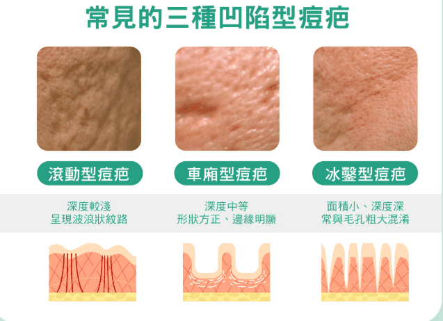 滾動 型 痘 疤