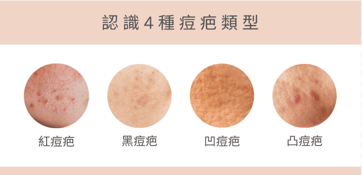 痘疤怎麼消
