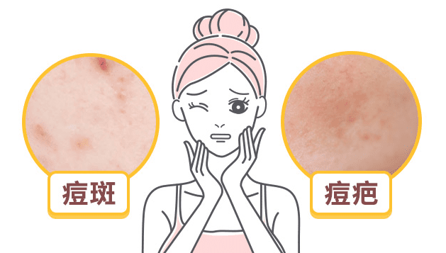 痘疤