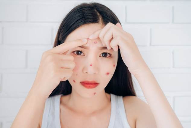 眉心長痘痘的原因 眉心長痘痘的原因