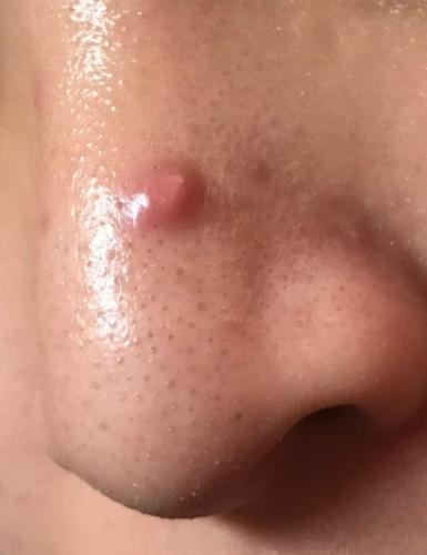 鼻樑長痘痘可以吃什麼