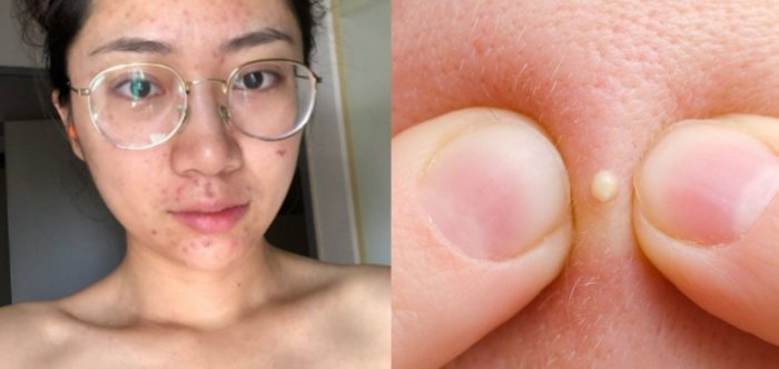 該怎麼擠痘痘