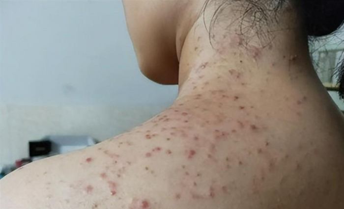 脖子後面長痘痘怎麼辦