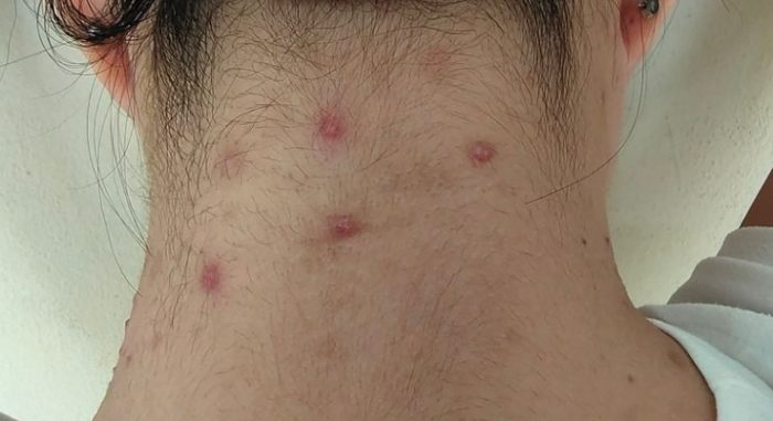 脖子後面長痘痘原因