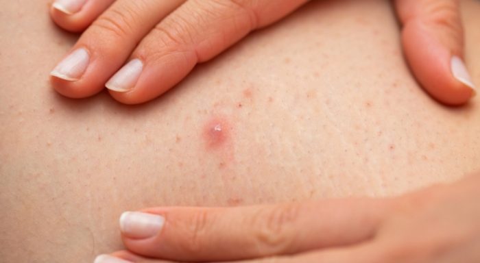 大腿長痘痘可以擠嗎