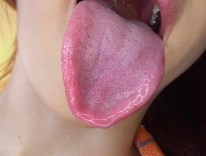 舌頭長痘痘怎麼辦