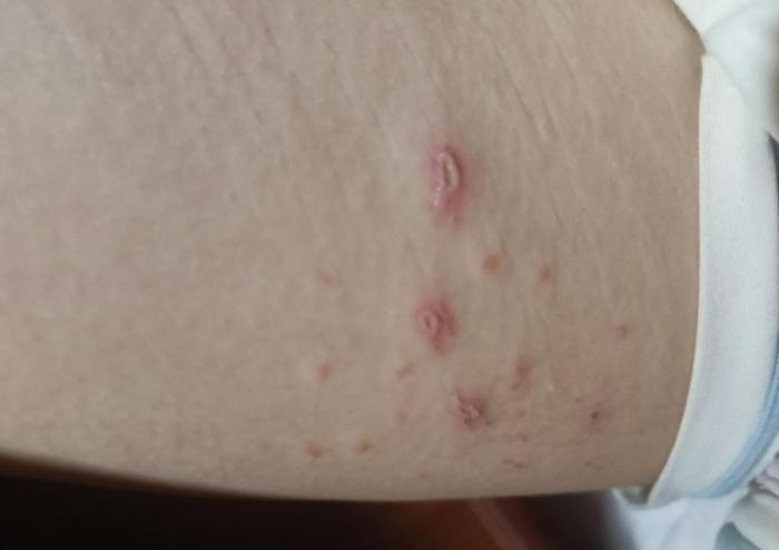 大腿長痘痘怎麼辦