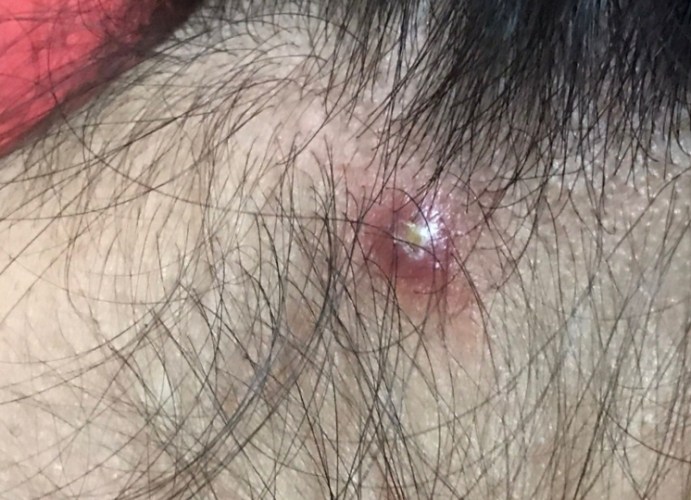 脖子長痘痘怎麼改善