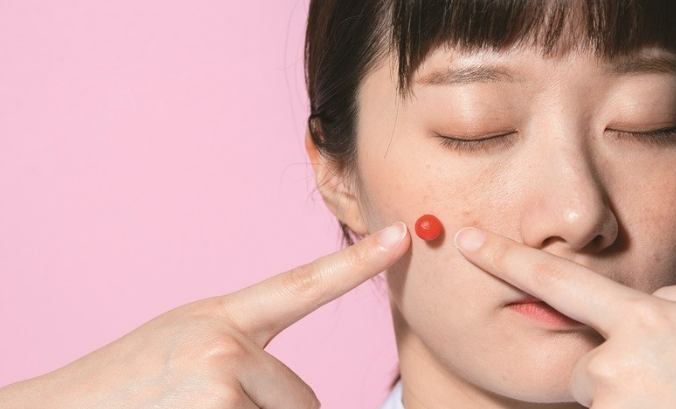 什麼類型的痘痘可以擠
