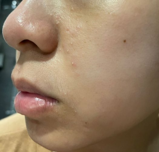 白頭粉刺能擠嗎