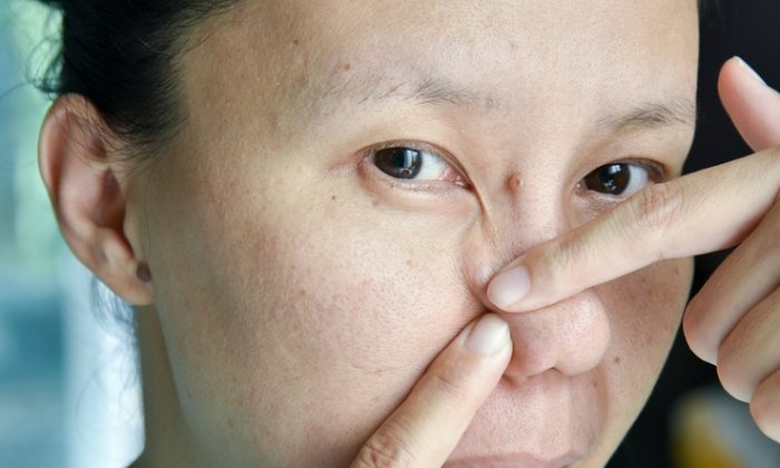 黑頭粉刺可以擠嗎
