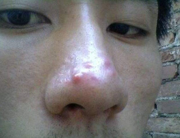 鼻樑長痘痘改善方法 鼻樑長痘痘改善方法