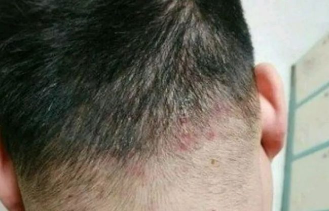 後腦勺長痘痘可以擠嗎