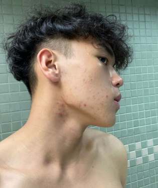 下顎稜線長痘痘症狀