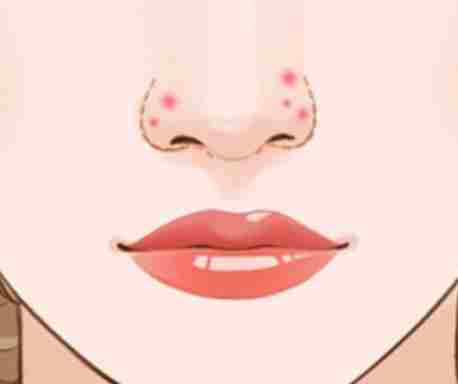 鼻翼長痘治療 鼻翼長痘治療