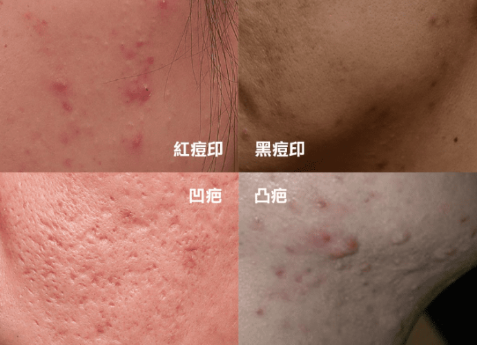 痘疤消除推薦方式