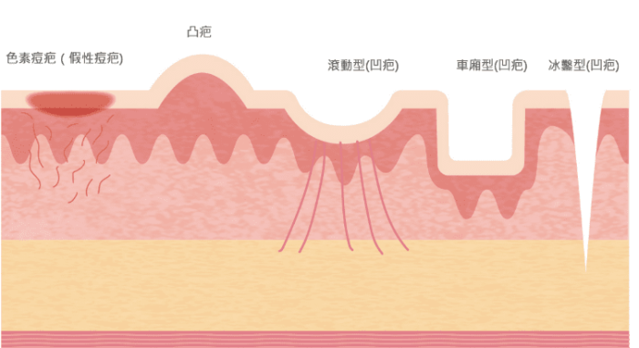 吃什麼食物可以淡疤