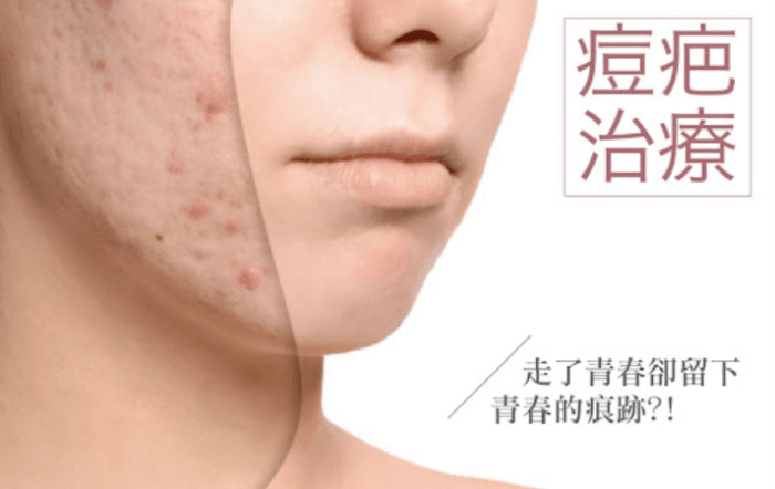 痘疤種類有哪些