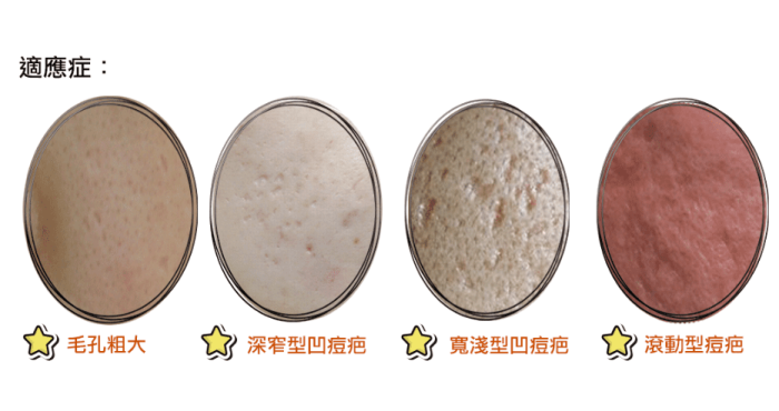 滾動型痘疤治療方法