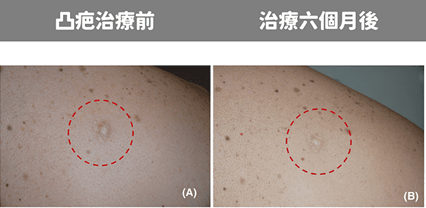  治療凸痘疤方法
