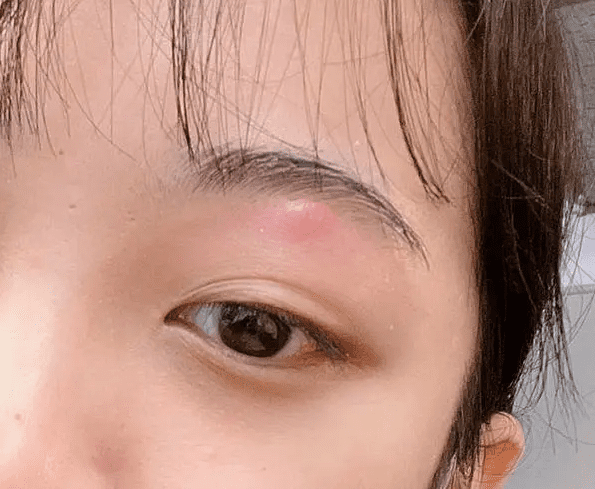 眼皮長痘痘 眼皮長痘痘