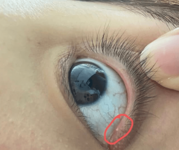 眼皮痘痘的注意事項