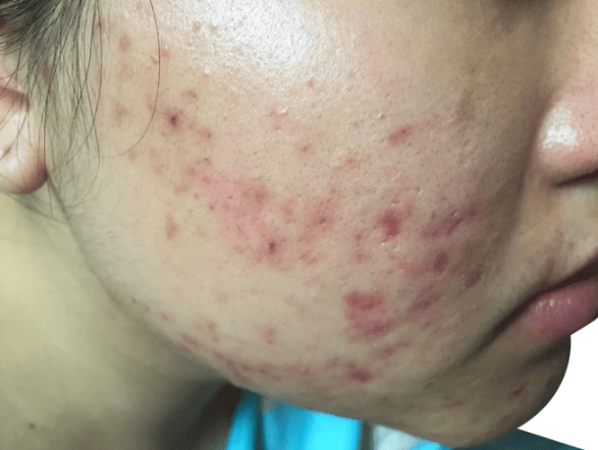 如何預防長痤瘡