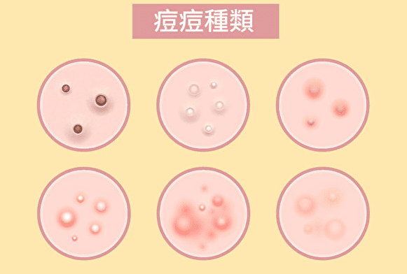 痘痘