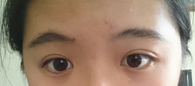 眉毛長痘痘怎麼消