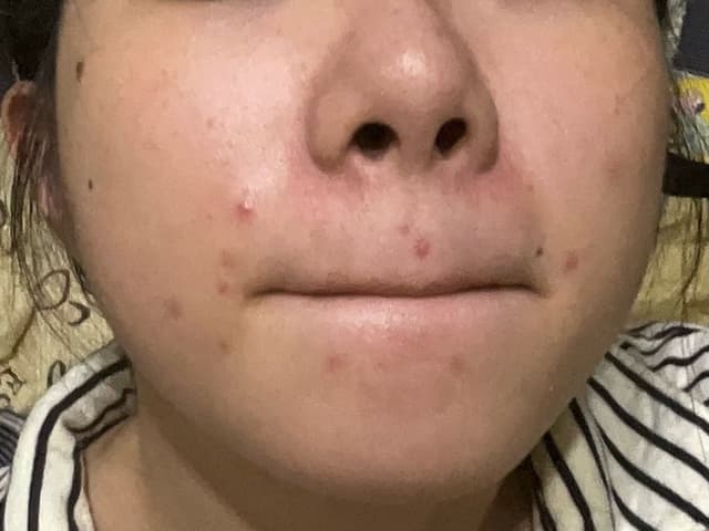 人中長痘痘原因