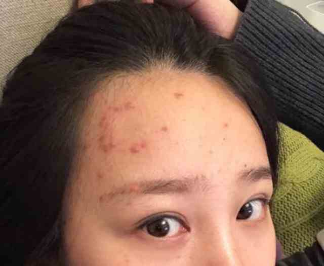 眉毛長痘痘原因