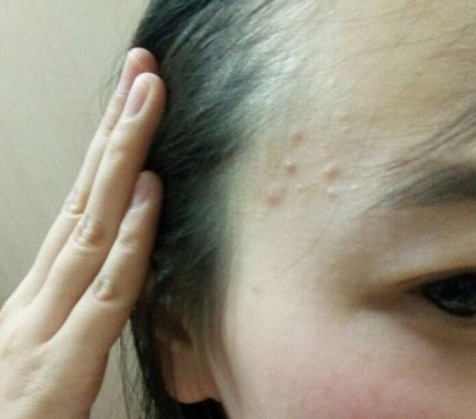 太陽穴長痘痘吃什麼
