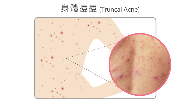 身體長痘痘吃什麼
